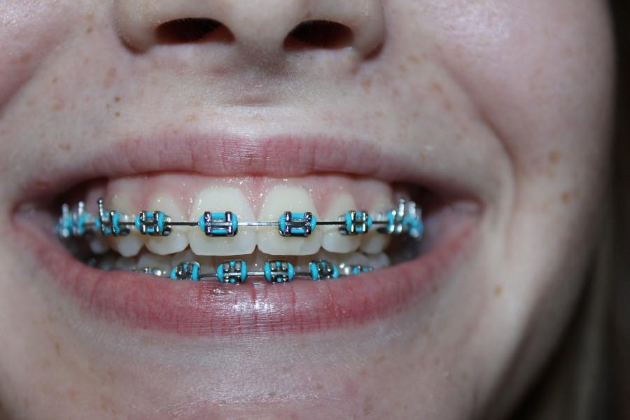 Sophomore Julia LaTrouno has had braces for six months, and still isnt used to the metal plastered on her teeth. 
